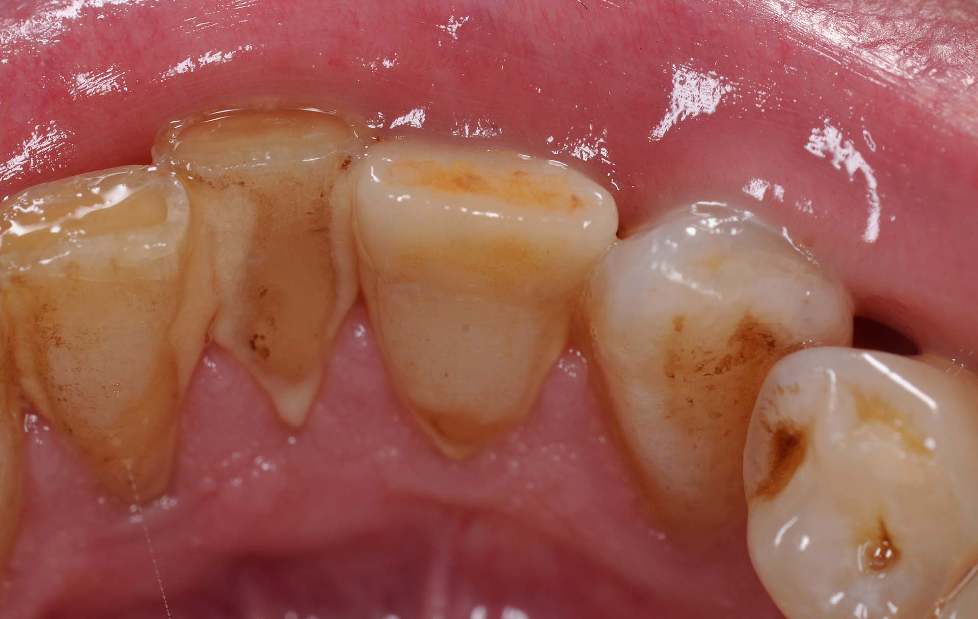 Veneer 32